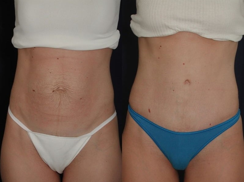 What Happens to Your Belly Button During a Tummy Tuck?
