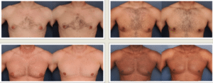 Gynecomastia Treatment Baltimore Male Breast Reduction