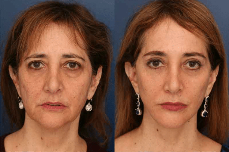 how-long-does-a-facelift-last-baltimore-dr-schuster