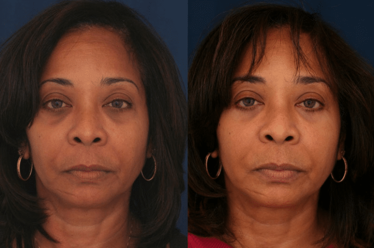 What is Transconjunctival Blepharoplasty? | Dr. Ronald Schuster