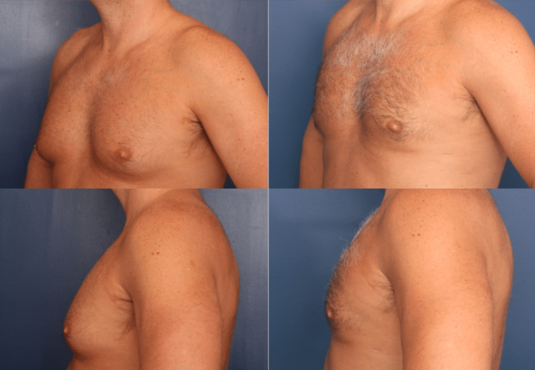 Can Gynecomastia Be Corrected with Liposuction?