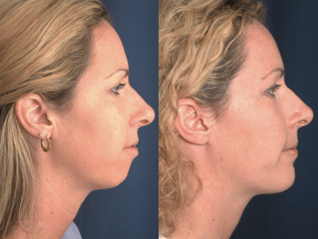 A before and after image of a woman who received a chin implant