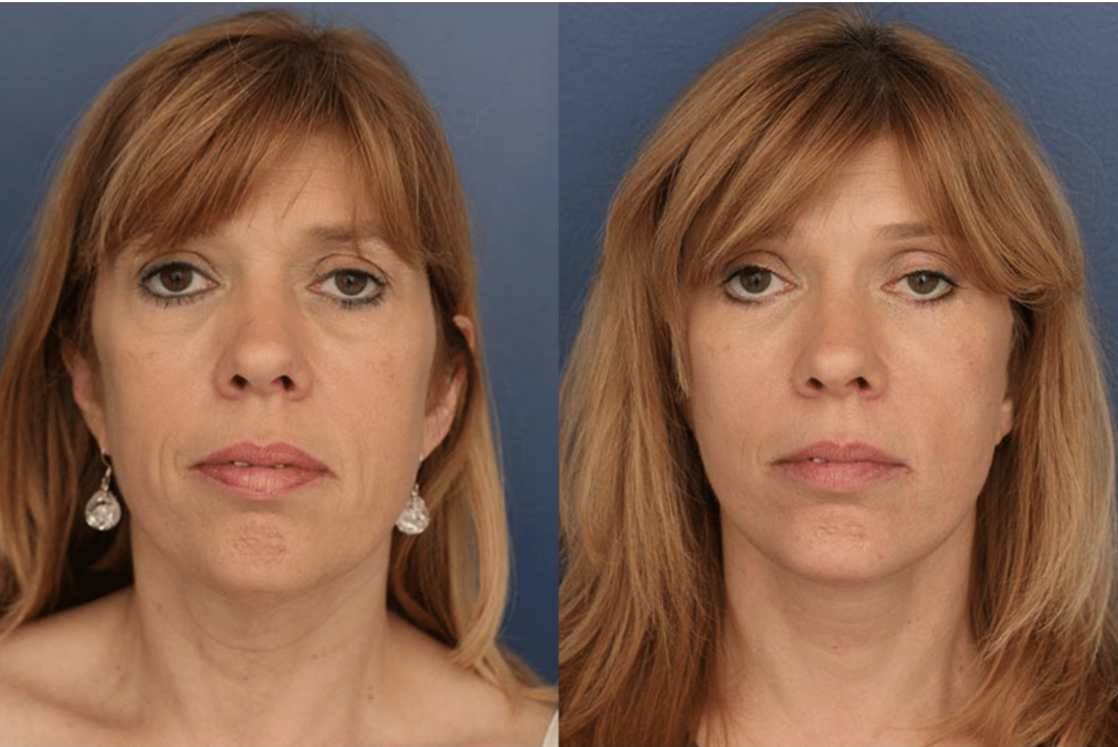 How Much Does A Facelift Cost Baltimore MD