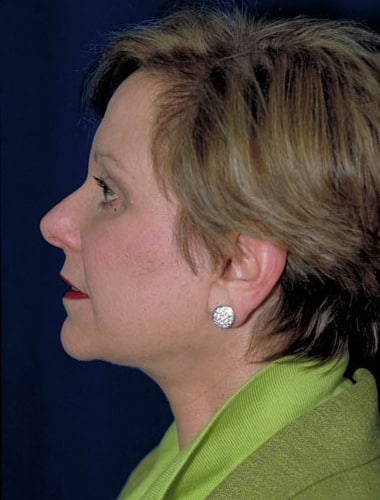 After Image: Facelift - left-side