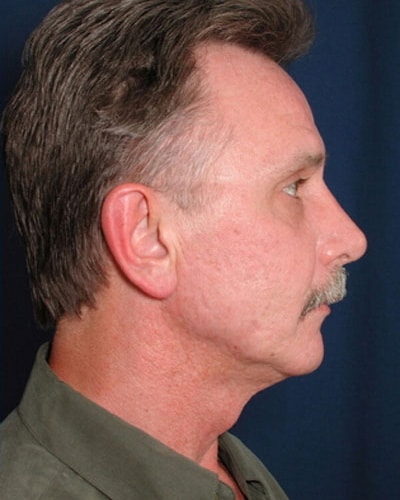 Before Image: Facelift - right-side