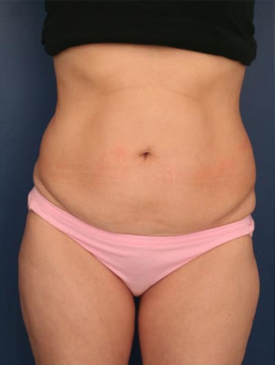 Before Image: Tummy Tuck - front