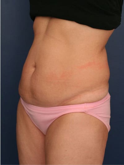 Before Image: Tummy Tuck - left-front-oblique