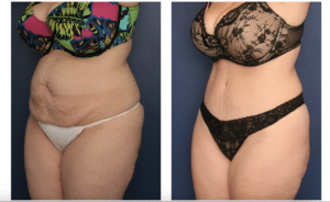 Woman revealing her abdomen before and after her tummy tuck by Dr. Schuster, looking more toned and slim.